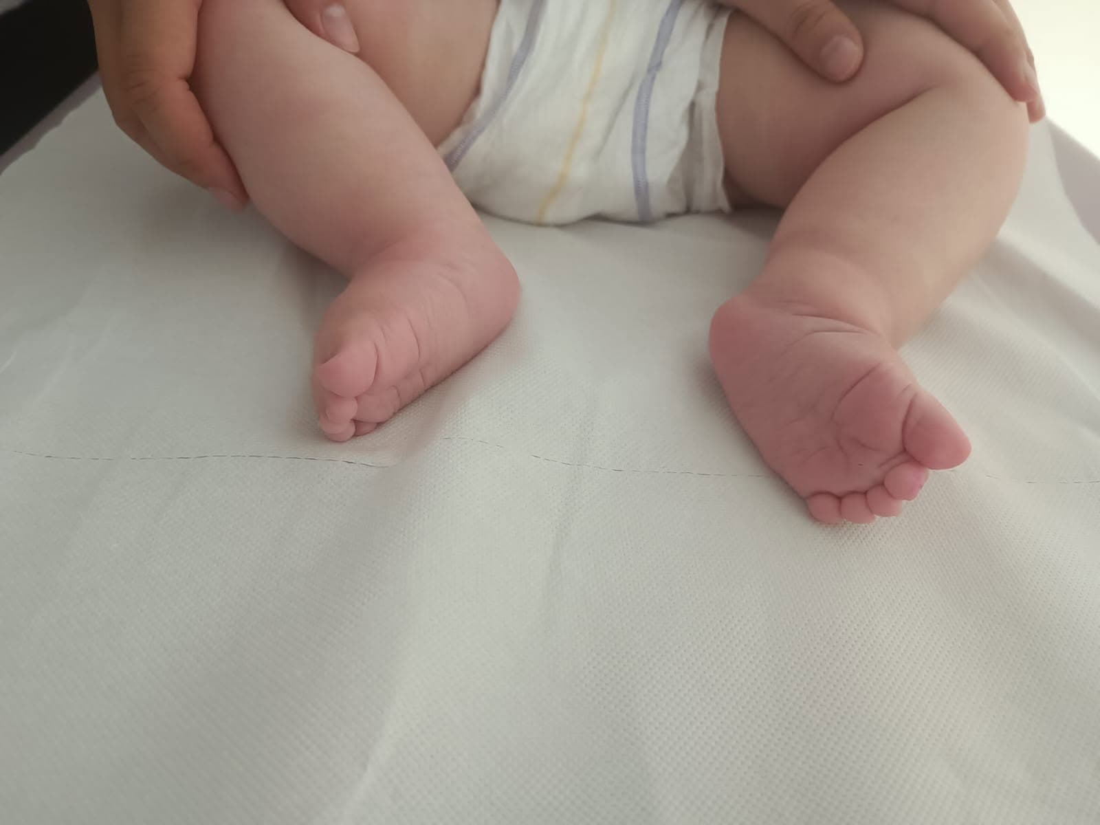 Tălpile corectate ale unui bebeluș după tratamentul prin metoda Ponseti