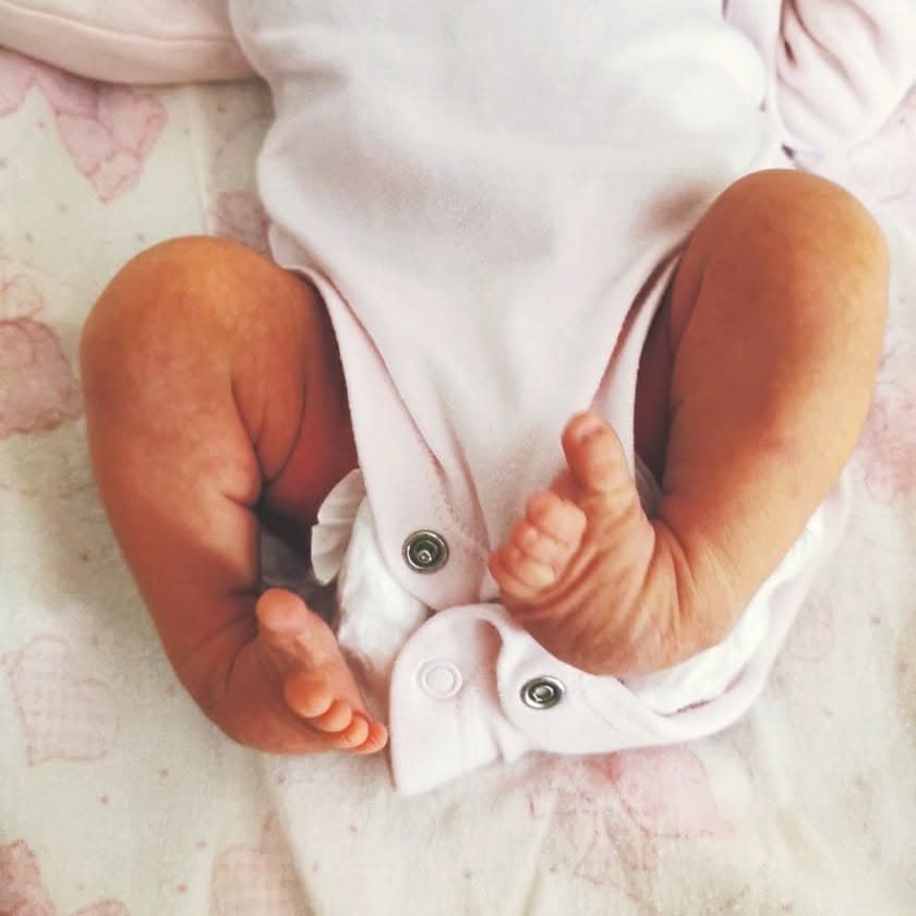 Piciorușele unui nou-născut cu picior strâmb congenital, întoarse spre interior, înainte de tratament